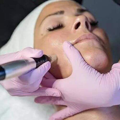 Microneedling