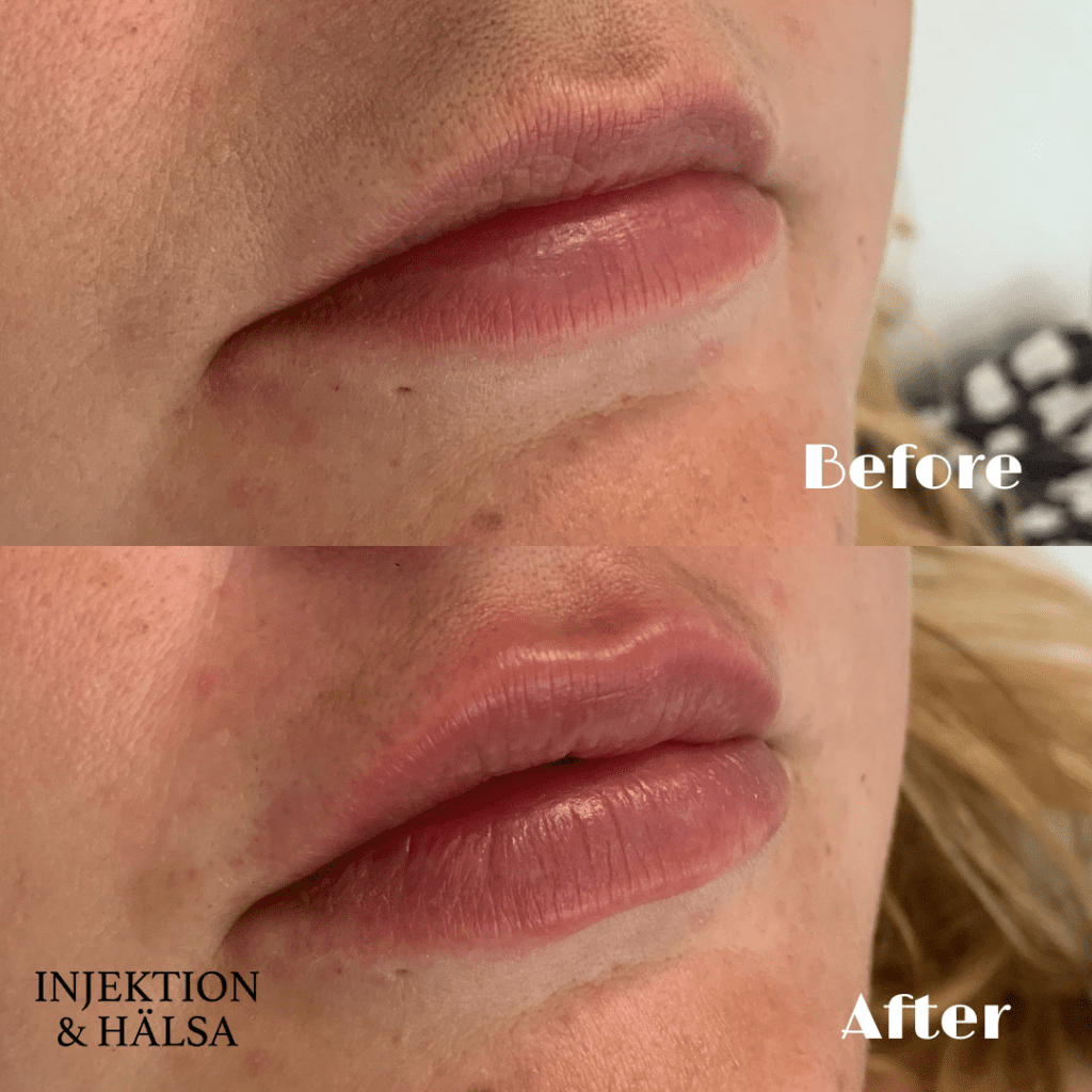 before-after-1-ml-filler