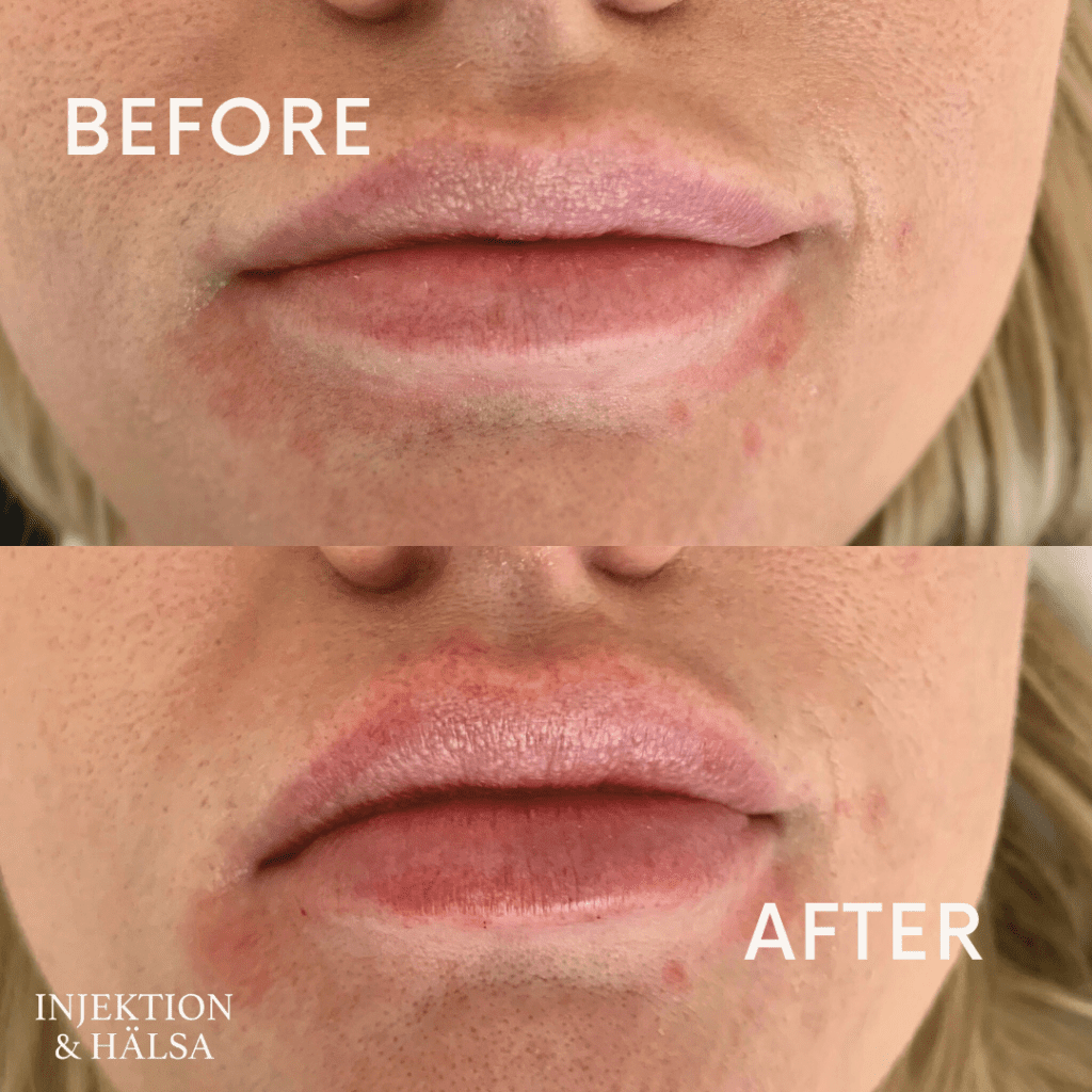 before-after-1-ml-filler-2