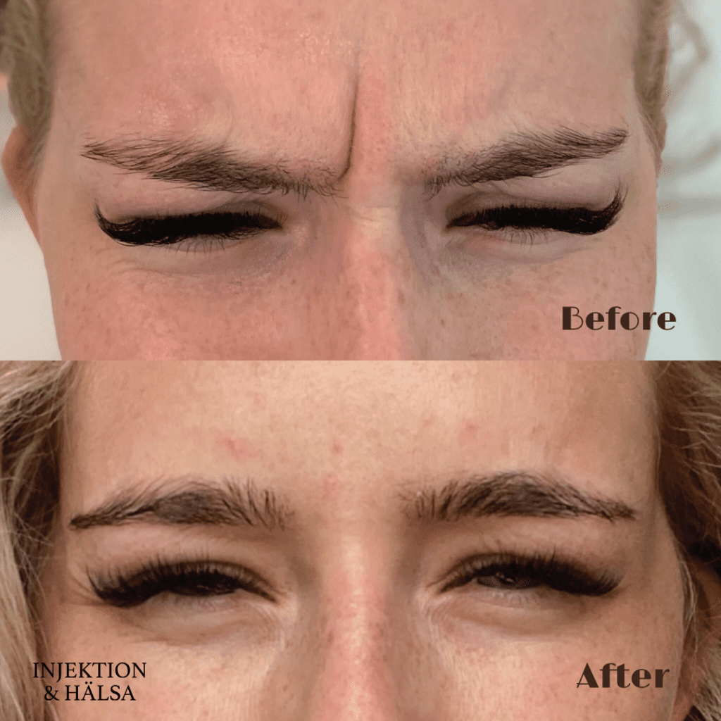 before-after-botox-glabella-arga-rynka-1-omrade