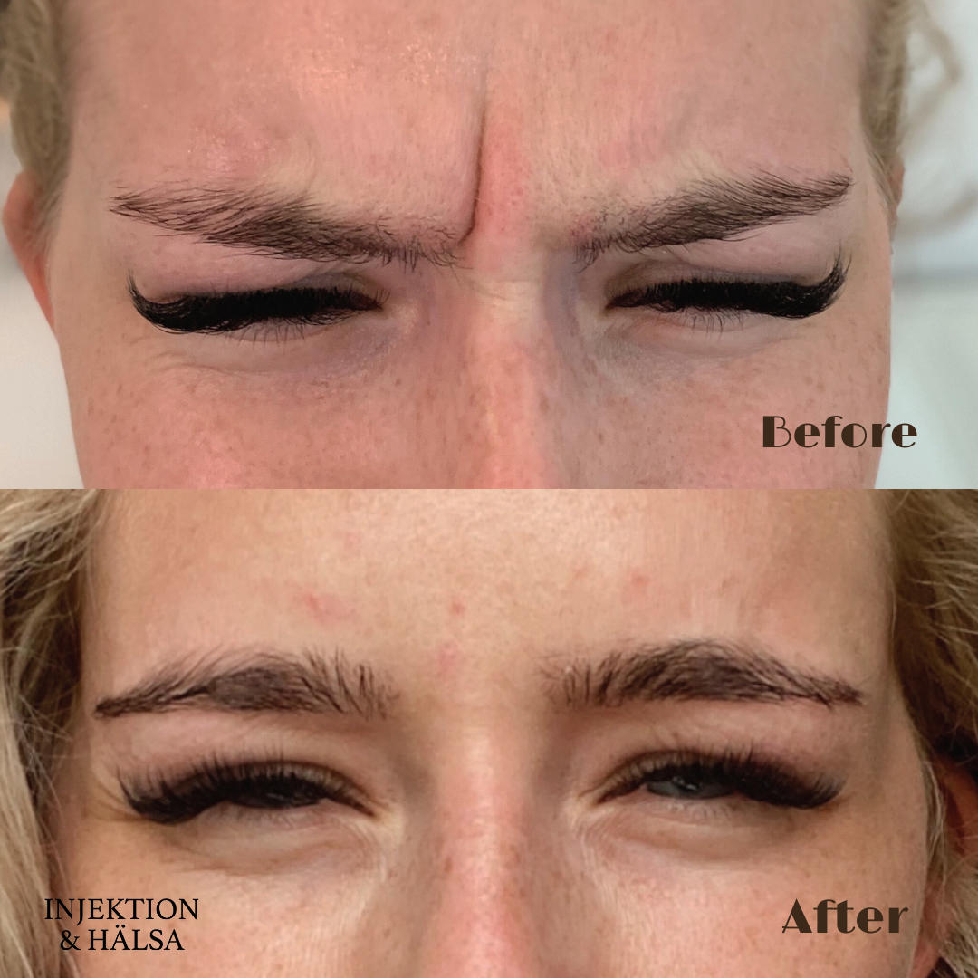 before-after-botox-glabella-arga-rynka-1-omrade