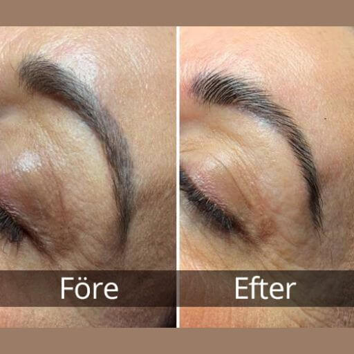 before-after-browlift