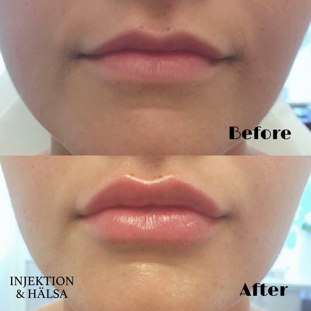 fillers-1ml-före-efterbild